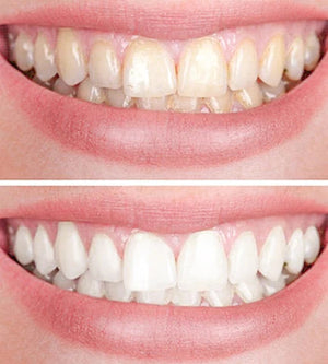 Clareador Dental Viya White - PROMOÇÃO (50% DE DESCONTO)