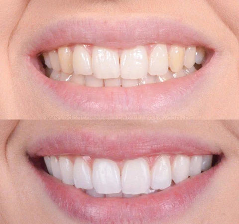 Clareador Dental Viya White - PROMOÇÃO (50% DE DESCONTO)