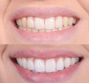 Clareador Dental Viya White - PROMOÇÃO (50% DE DESCONTO)