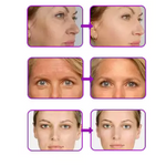 CollagenoPro© + Ácido Hialurônico [Efeito Botox]