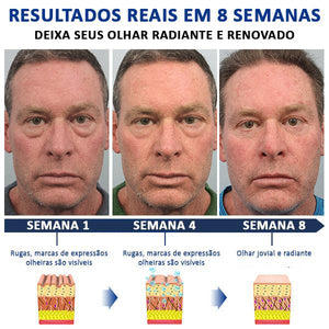 Creme HIMSE© - Removedor de bolsas e olheiras
